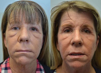 CO2 Laser Resurfacing Before & After Gallery - Patient 4588426 - Image 1
