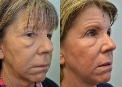 CO2 Laser Resurfacing Before & After Gallery - Patient 4588426 - Image 2