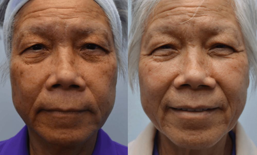 CO2 Laser Resurfacing Before & After Gallery - Patient 4588427 - Image 1