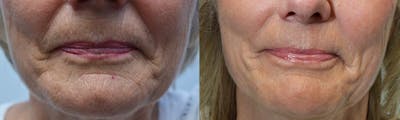CO2 Laser Resurfacing Before & After Gallery - Patient 4588437 - Image 1