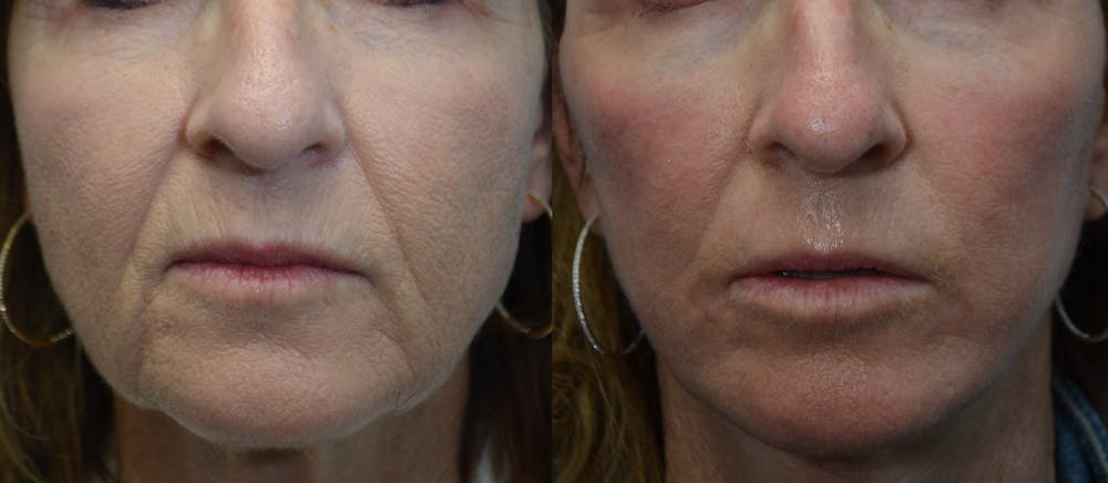 CO2 Laser Resurfacing Before & After Gallery - Patient 4588437 - Image 3