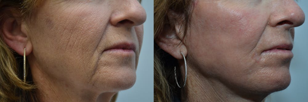 CO2 Laser Resurfacing Before & After Gallery - Patient 4588437 - Image 4