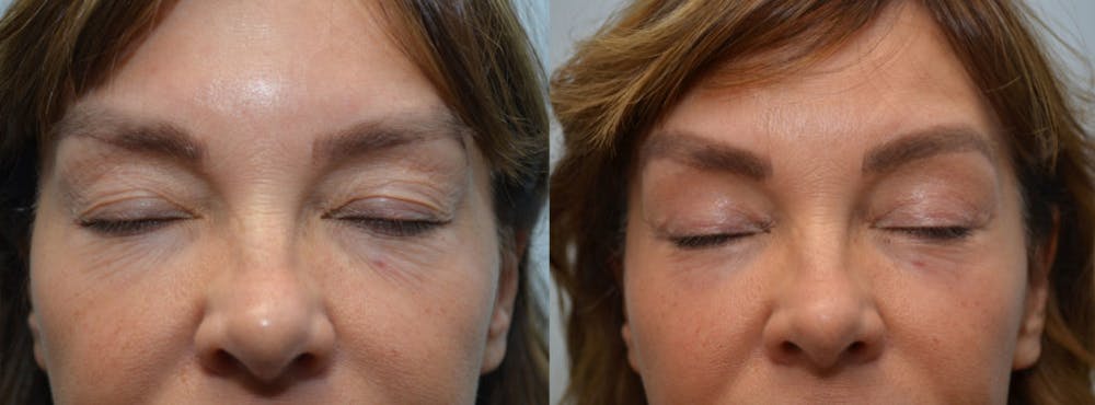 Forma Before & After Gallery - Patient 4588485 - Image 2