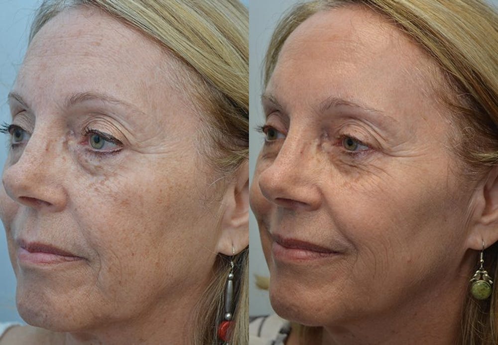 IPL / PhotoFacial Before & After Gallery - Patient 4588488 - Image 1