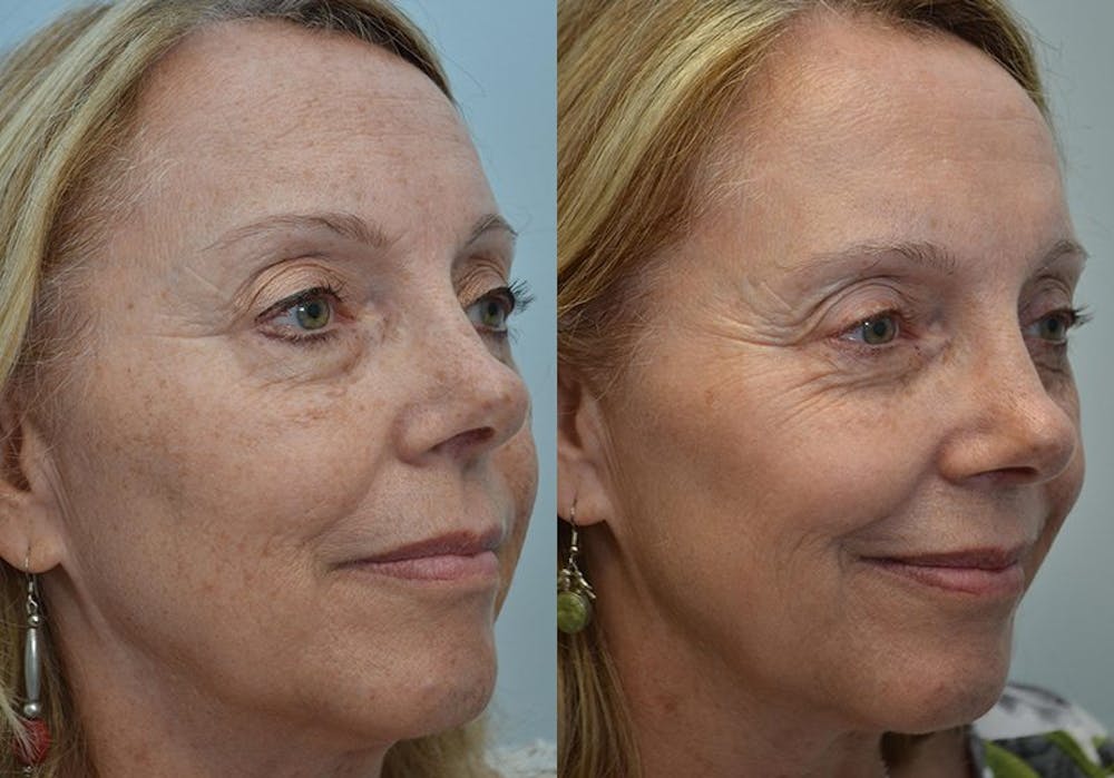 IPL / PhotoFacial Before & After Gallery - Patient 4588488 - Image 2