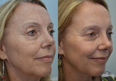 IPL / PhotoFacial Before & After Gallery - Patient 4588488 - Image 2