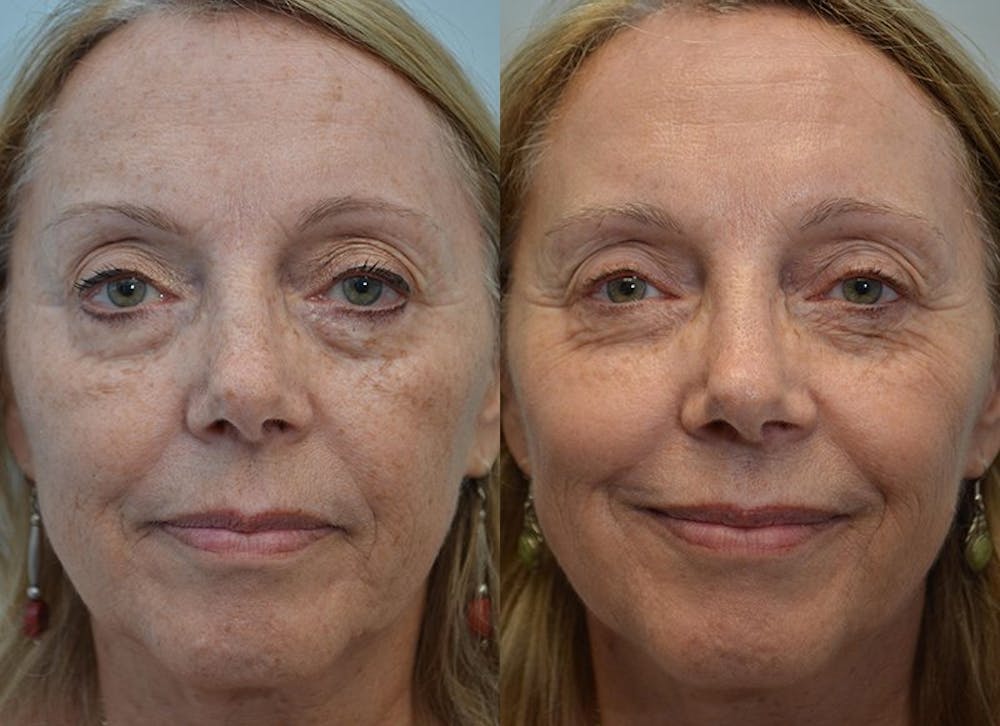 IPL / PhotoFacial Before & After Gallery - Patient 4588488 - Image 3