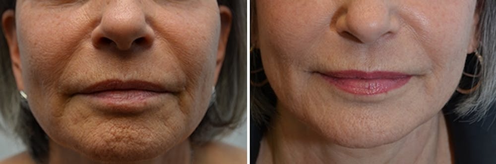 Micro Needling Before & After Gallery - Patient 4588489 - Image 1