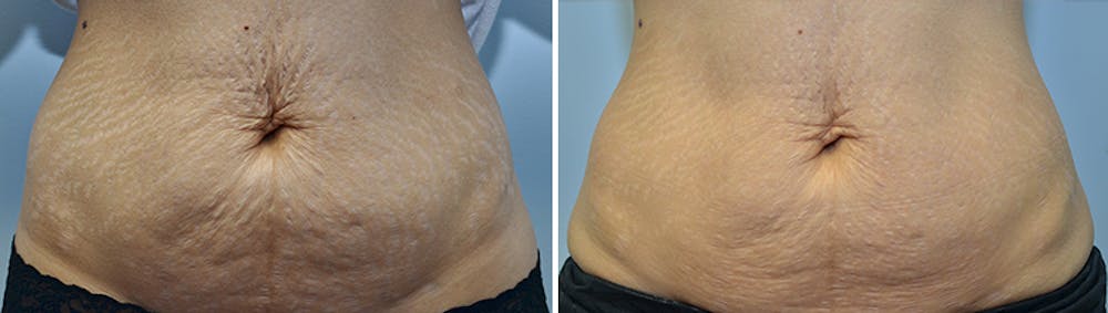 Micro Needling Before & After Gallery - Patient 4588491 - Image 1