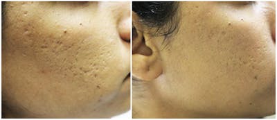 Micro Needling Before & After Gallery - Patient 4588493 - Image 1