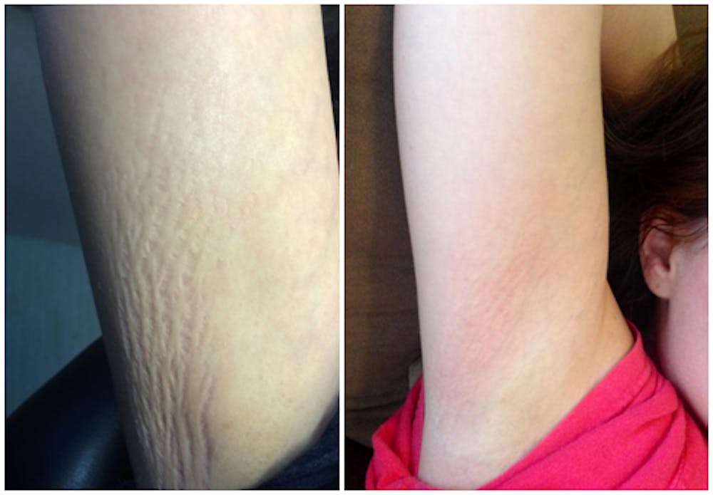 Micro Needling Before & After Gallery - Patient 4588499 - Image 1