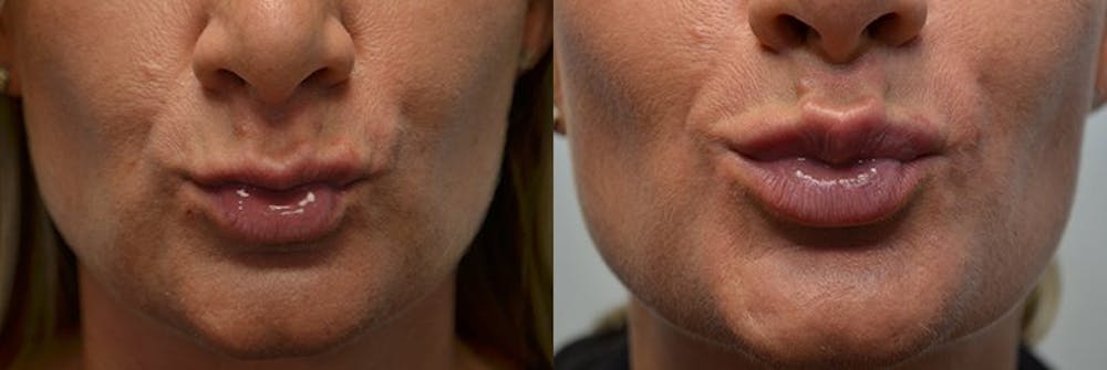 Lip Enhancement Before & After Gallery - Patient 4588505 - Image 2