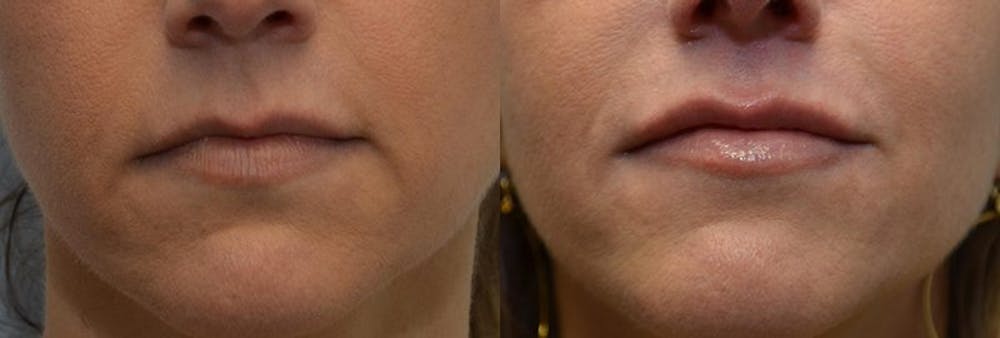 Lip Enhancement Before & After Gallery - Patient 4588507 - Image 1