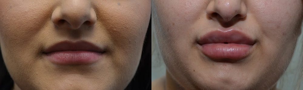Lip Enhancement Before & After Gallery - Patient 4588510 - Image 1
