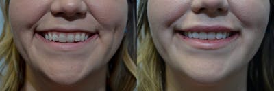 Lip Enhancement Before & After Gallery - Patient 4588521 - Image 2