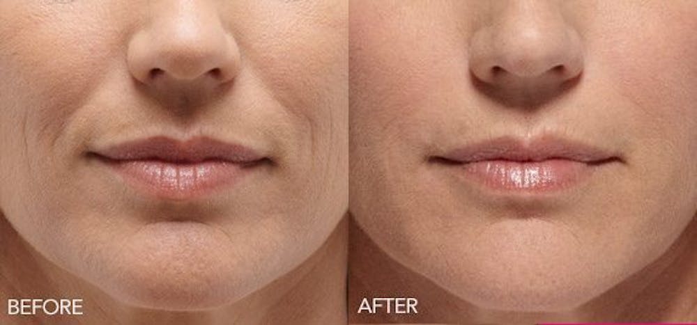 Lip Enhancement Before & After Gallery - Patient 4588524 - Image 1