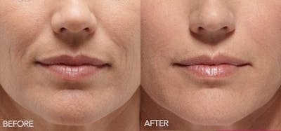 Lip Enhancement Before & After Gallery - Patient 4588524 - Image 1