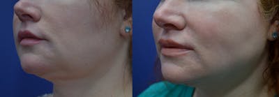 Lip Augmentation Before & After Gallery - Patient 4588530 - Image 2