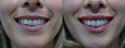 Lip Enhancement Before & After Gallery - Patient 4588526 - Image 2