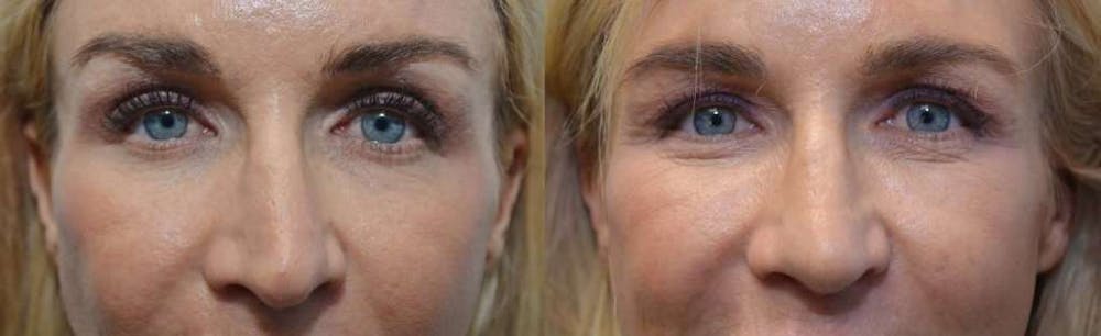 Revision Rhinoplasty Before & After Gallery - Patient 4588535 - Image 2