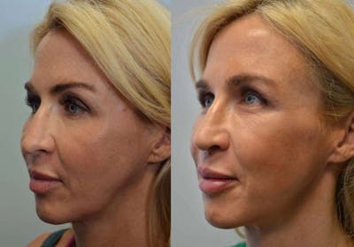 Revision Rhinoplasty Before & After Gallery - Patient 4588535 - Image 1