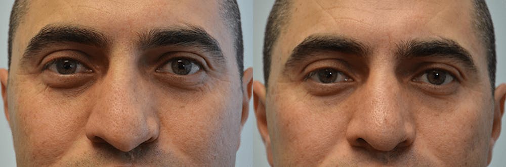 Revision Rhinoplasty Before & After Gallery - Patient 4588546 - Image 3