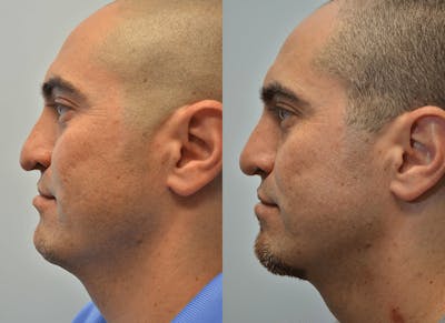 Revision Rhinoplasty Before & After Gallery - Patient 4588546 - Image 2