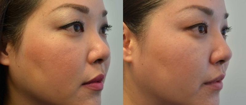 Non-Surgical Rhinoplasty