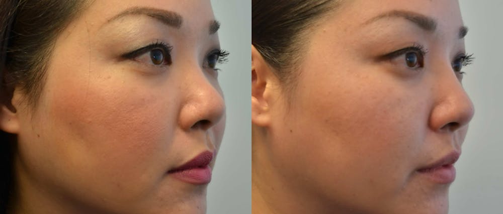 Non-Surgical Augmentation Before & After Gallery - Patient 4588551 - Image 1