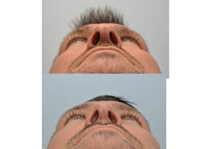Rhinoplasty (Nose Reshaping) Before & After Gallery - Patient 4588554 - Image 4