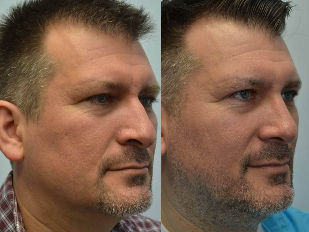 Rhinoplasty (Nose Reshaping) Before & After Gallery - Patient 4588554 - Image 2