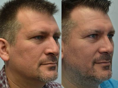 Rhinoplasty (Nose Reshaping) Before & After Gallery - Patient 4588554 - Image 2