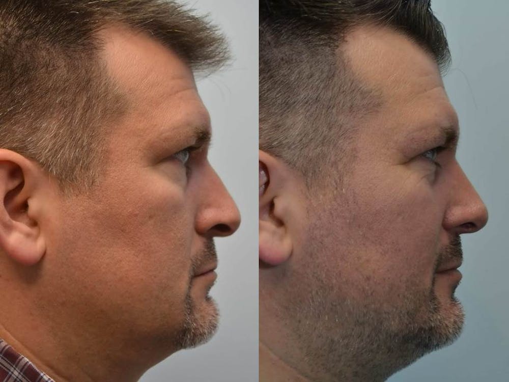 Rhinoplasty (Nose Reshaping) Before & After Gallery - Patient 4588554 - Image 3