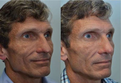 Rhinoplasty (Nose Reshaping) Before & After Gallery - Patient 4588555 - Image 2