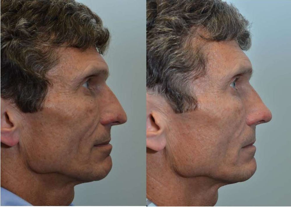 Rhinoplasty (Nose Reshaping) Before & After Gallery - Patient 4588555 - Image 3