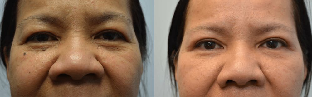 Rhinoplasty (Nose Reshaping) Before & After Gallery - Patient 4588556 - Image 1