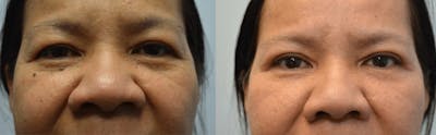 Rhinoplasty (Nose Reshaping) Before & After Gallery - Patient 4588556 - Image 1