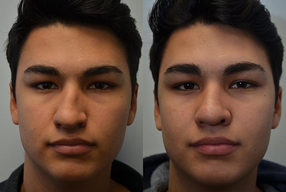 Rhinoplasty (Nose Reshaping) Before & After Gallery - Patient 4588559 - Image 1