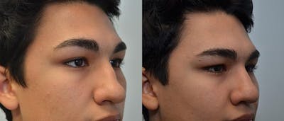 Rhinoplasty (Nose Reshaping) Before & After Gallery - Patient 4588559 - Image 2