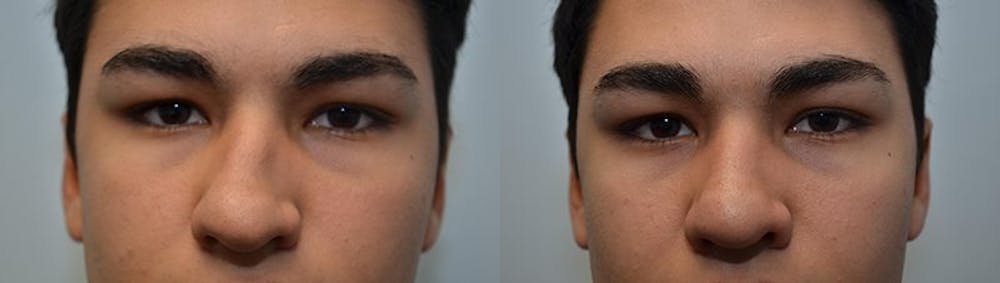 Rhinoplasty (Nose Reshaping) Before & After Gallery - Patient 4588559 - Image 3