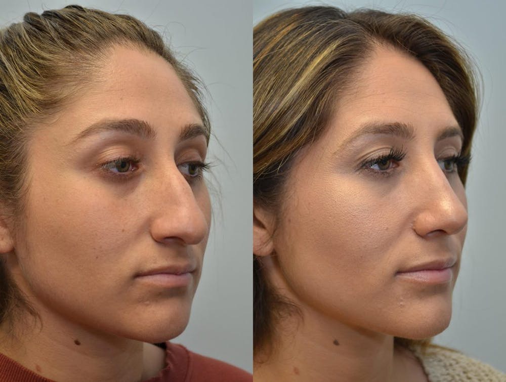 Rhinoplasty (Nose Reshaping) Before & After Gallery - Patient 4588561 - Image 2