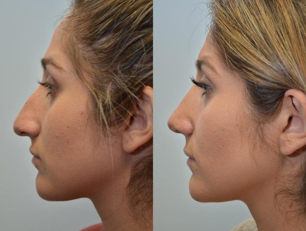 Rhinoplasty (Nose Reshaping) Before & After Gallery - Patient 4588561 - Image 3