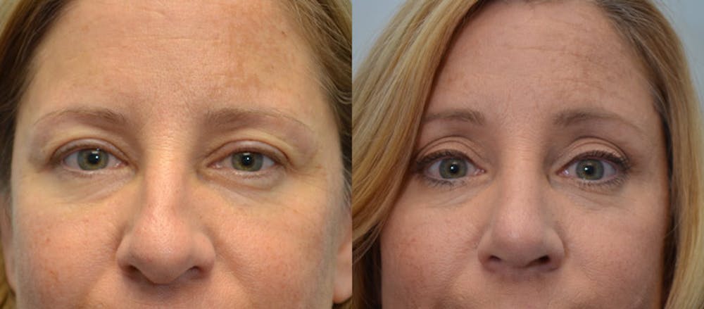 Rhinoplasty (Nose Reshaping) Before & After Gallery - Patient 4588562 - Image 1