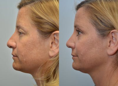 Rhinoplasty (Nose Reshaping) Before & After Gallery - Patient 4588562 - Image 2