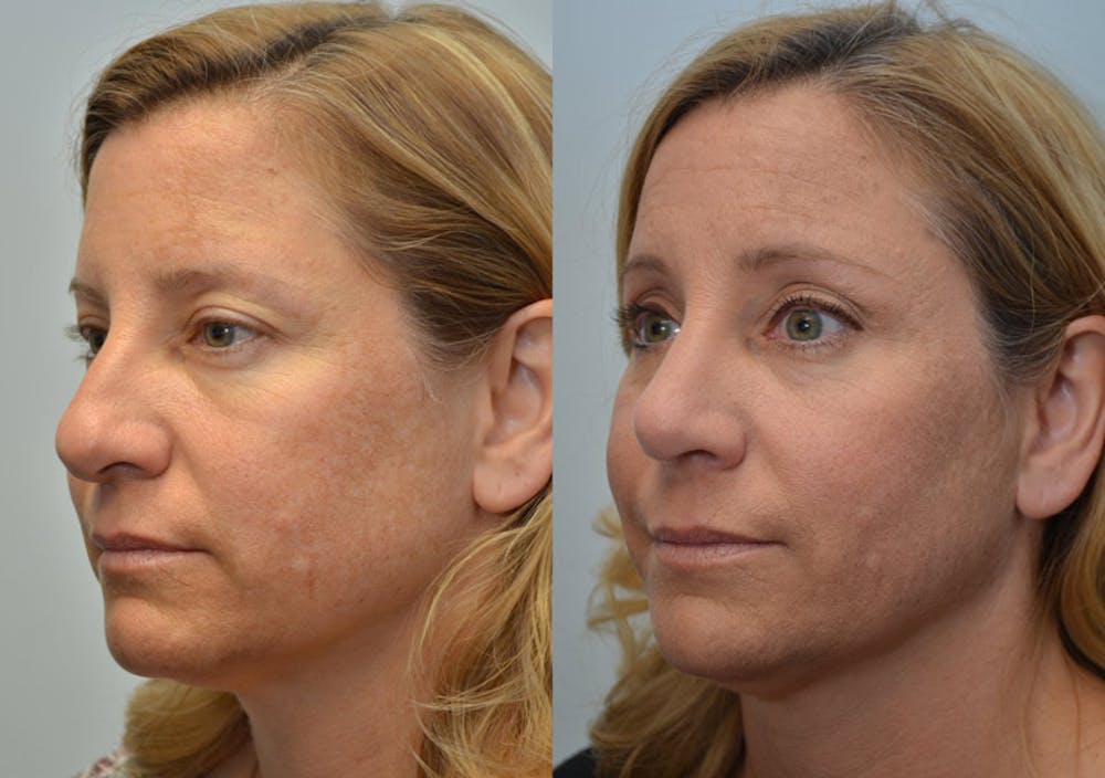 Rhinoplasty (Nose Reshaping) Before & After Gallery - Patient 4588562 - Image 3