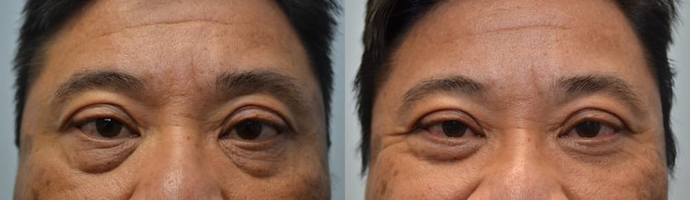 Asian Eyelid Surgery Before & After Gallery - Patient 4588565 - Image 1