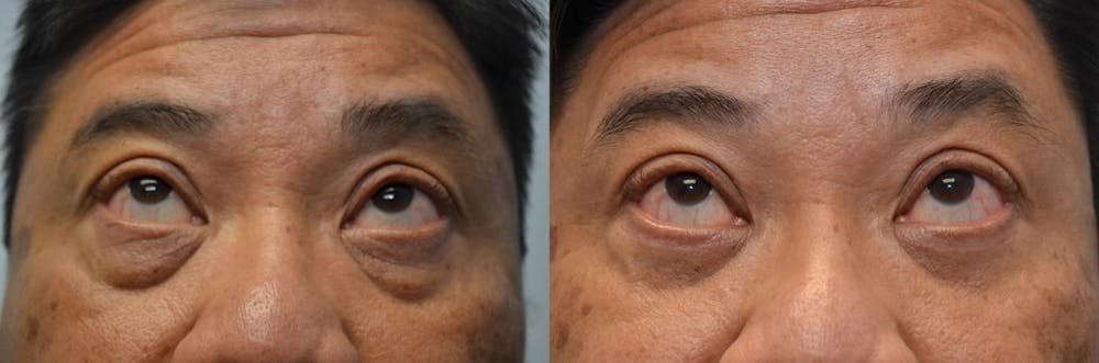 Asian Eyelid Surgery Before & After Gallery - Patient 4588565 - Image 2