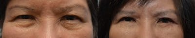 Asian Eyelid Surgery Before & After Gallery - Patient 4588567 - Image 1
