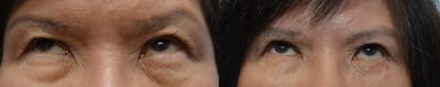 Asian Eyelid Surgery Before & After Gallery - Patient 4588567 - Image 2