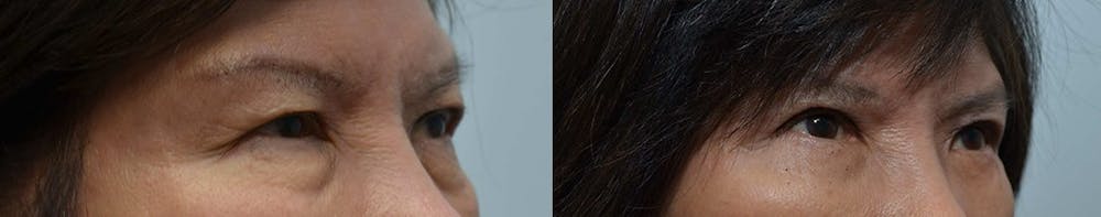 Asian Eyelid Surgery Before & After Gallery - Patient 4588567 - Image 3
